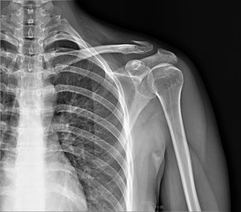 radiography of the shoulder joint and ribs in direct projection with a fracture of the collarbone,...