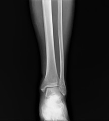 normal radiograph of the ankle joint in front projection,osteoarthritis osteoporosis