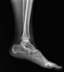 normal radiography of the ankle joint in the lateral projection
