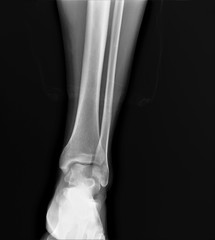 normal radiograph of the ankle joint in front projection,osteoarthritis osteoporosis