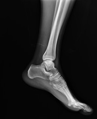 normal radiography of the ankle joint in the lateral projection
