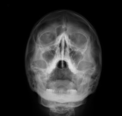 radiography of the paranasal sinuses of the skull, medical diagnosis