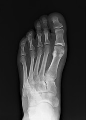 normal radiography of the foot, medical diagnostics, traumatology and orthopedics, rheumatology