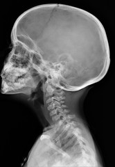 radiography of the cervical spine, traumatology, medical diagnostics