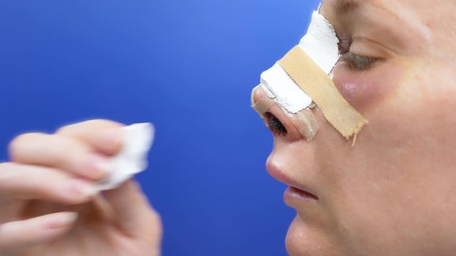 Closeup of a female face on the second day after rhinoplasty. bandage on the nose, swelling and bruising on the face