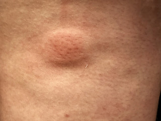 Fototapeta premium Swollen Mosquito Bite