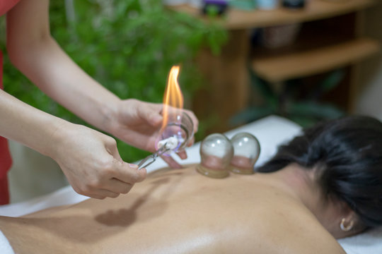 Acupuncture therapist removing a fire cupping glass from the back of a young woman