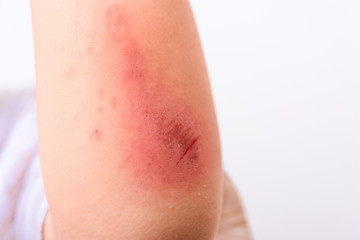 Asian boy kid show arm accident wound he painful abrasion scratches from fall