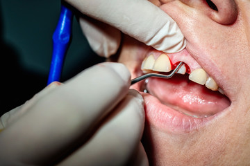 Bleeding gums around the prosthetic tooth and doctor hands with tool.