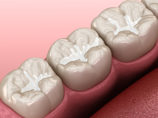 Molar Fissure dental fillings, Medically accurate 3D illustration of dental concept - 308193061