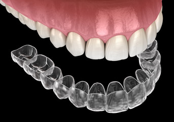 Invisalign braces or invisible retainer. Medically accurate dental 3D illustration