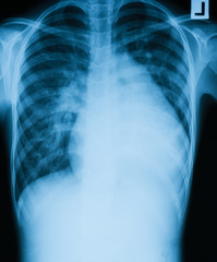 Chest X-ray image of a young boy, case of enlarged heart or cardiomegaly - obrazy, fototapety, plakaty