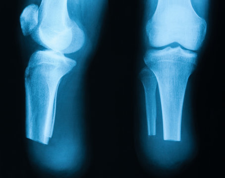 X-ray image of amputated lower leg, anteropostrior (AP) view and lateral view
