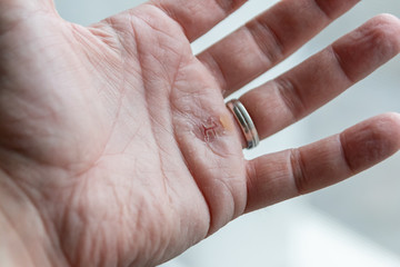 Verletzte Männerhand eines Europäers mit Brandblase heilt langsam durch medikamentöse Behandlung...