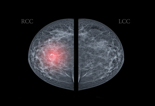  X-ray Digital Mammogram  or mammography  both side of the breast  CC view  for finding Breast cancer in women  showing Breast Calcifications in right breast.
