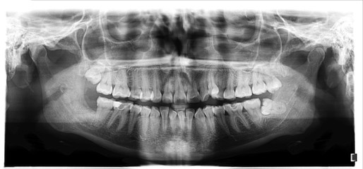 Panoramic image of the jaw, the location of the atypical / pathological wisdom tooth (third molar)....