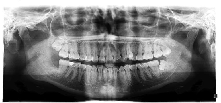 Panoramic image of the jaw, the location of the atypical / pathological wisdom tooth (third molar). Medical research, maxillofacial surgery.