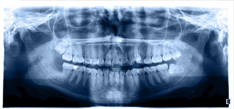 Close up. Panoramic image of the jaw, the location of the atypical / pathological wisdom tooth (third molar). Blue tone image.