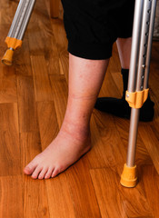 Woman leg injury hematoma after ancle sprain