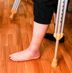 Woman leg injury hematoma after ancle sprain