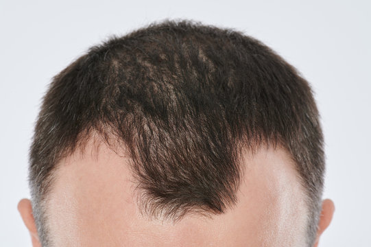 Damaged man hair