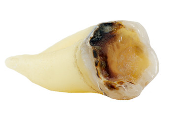 extracted caries tooth isolated on white background close-up macro, lower molar