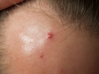 Fototapeta premium pimple on the forehead close-up, acne