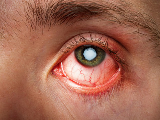 conjunctivitis, conjunctival inflammation, red eyes, infection and inflammation, close up eye - obrazy, fototapety, plakaty