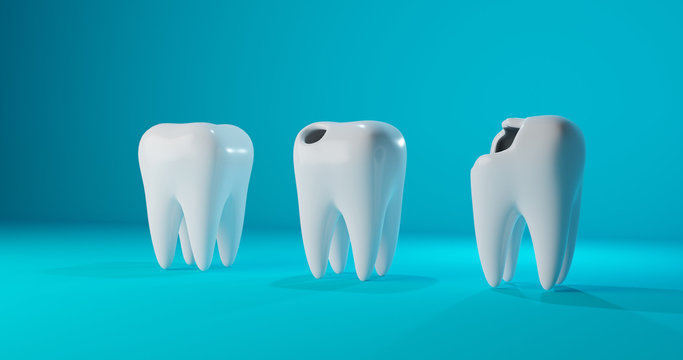 Image of three different teeth: a healthy tooth, teeth with a hole and caries. Concept for dental clinic, medicine, treatment of children's teeth design. 3d render illustration.