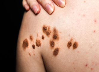 Fototapeta premium Big birthmarks and freckles on the girl's skin. Medical health photo of back. Woman's oily skin with problems acne.