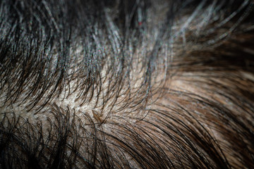 Louse egg on the hair causes itchy head.