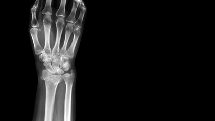 Film X ray wrist radiograph show distal forearm bone broken ( distal end radius fracture). The patient has wrist pain, swelling and deformity. Medical imaging for investigation and technology concept - obrazy, fototapety, plakaty
