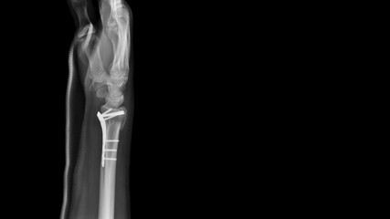 Film X-ray wrist radiograph show forearm bone broken (distal end radius fracture) operative...