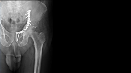 Film X ray hip radiograph show broken hip bone or fracture acetabulum disease treated by surgery...