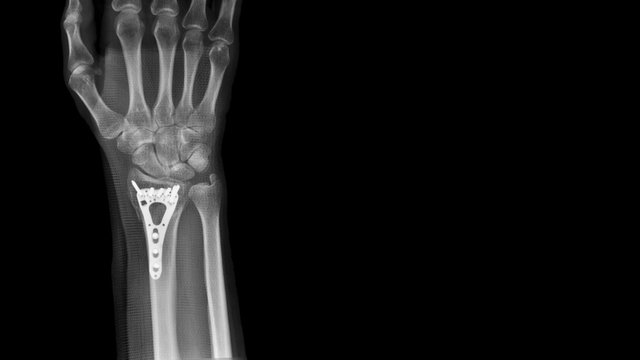 Film X-ray wrist radiograph show forearm bone broken (distal end radius fracture) operative treatment by plate and screws fixation surgery. Orthopedic procedure and medical technology concept.