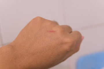 Fototapeta premium Wound on the hand from the scratch, little lesion on hand.