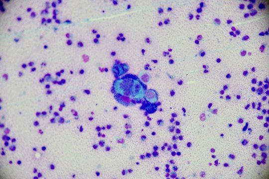 Mononuclear and multinucleated cell (Tzanck smear ,Abnormal Human cells , Medical technologist)