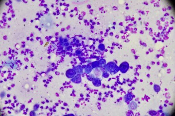 Mononuclear and multinucleated cell (Tzanck smear ,Abnormal Human cells , Medical technologist)