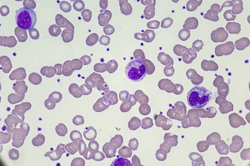 White blood celll (Band form and Neutrophil)