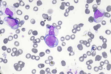 Blast cell (Acute myeloid leukemia in Human)