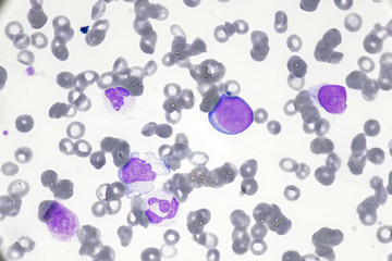 Blast cell (Acute myeloid leukemia in Human)