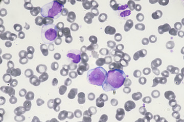 Blast cell (Acute myeloid leukemia in Human)