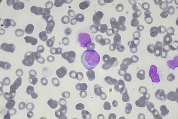 Blast cell (Acute myeloid leukemia in Human)