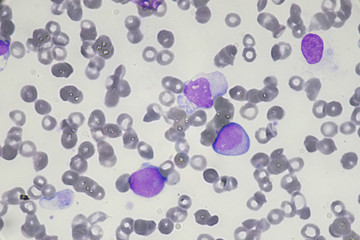 Blast cell (Acute myeloid leukemia in Human)