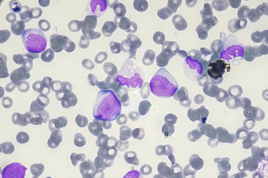 Blast Cell In Acute Myeloid Leukemia From Human Blood Cells (White Blood Cells Cancer , Bone Marrow Aspirate)