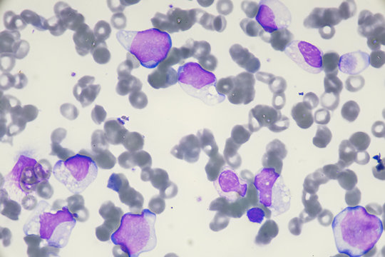 Blast cell in Acute myeloid leukemia from human blood cells (White blood cells cancer , Bone marrow aspirate)