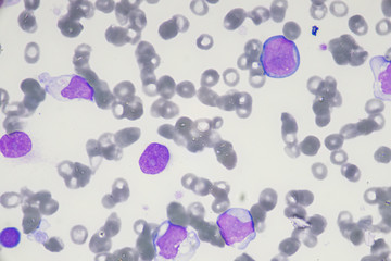 Blast cell in Acute myeloid leukemia from human blood cells (White blood cells cancer , Bone marrow aspirate)