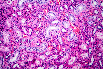 Histopathology of hypertensive renal disease, light micrograph, photo under microscope
