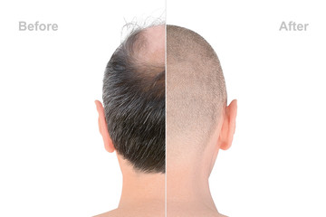 Hair loss. Before and after transplantation. Rear view of male bald head on white background,...