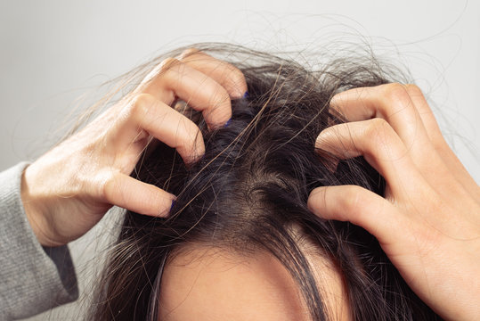 Closeup Woman Hand Itchy Scalp, Hair Care Concept